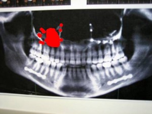 screw removal, just as sexy as it sounds